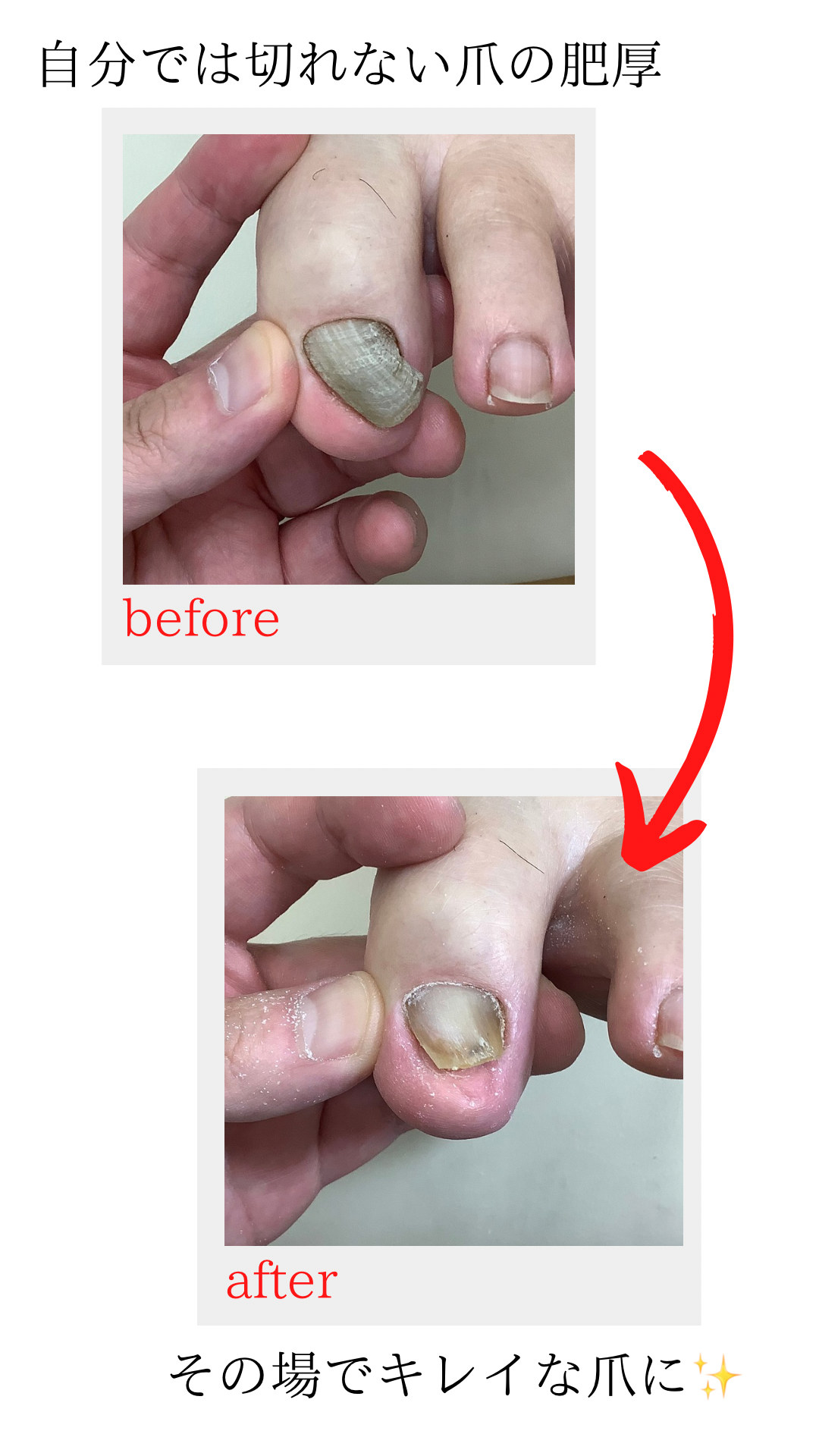 分厚い爪・肥厚爪の施術