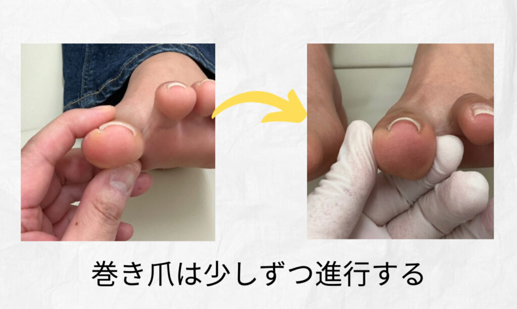 巻き爪は進行する