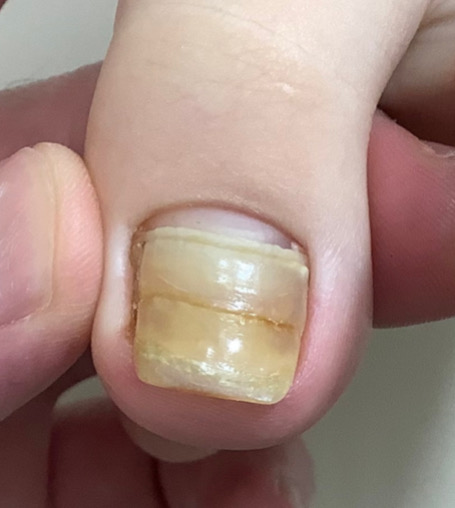 変形した爪