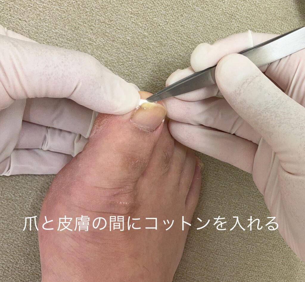 巻き爪の応急処置法