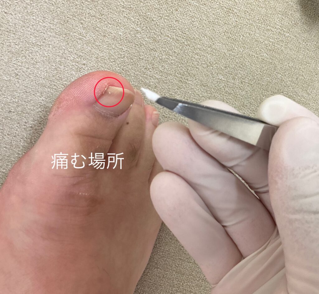 巻き爪の応急処置法