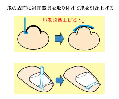 巻き爪補正器具を装着