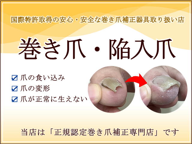 巻き爪・陥入爪・変形爪の正規取扱店