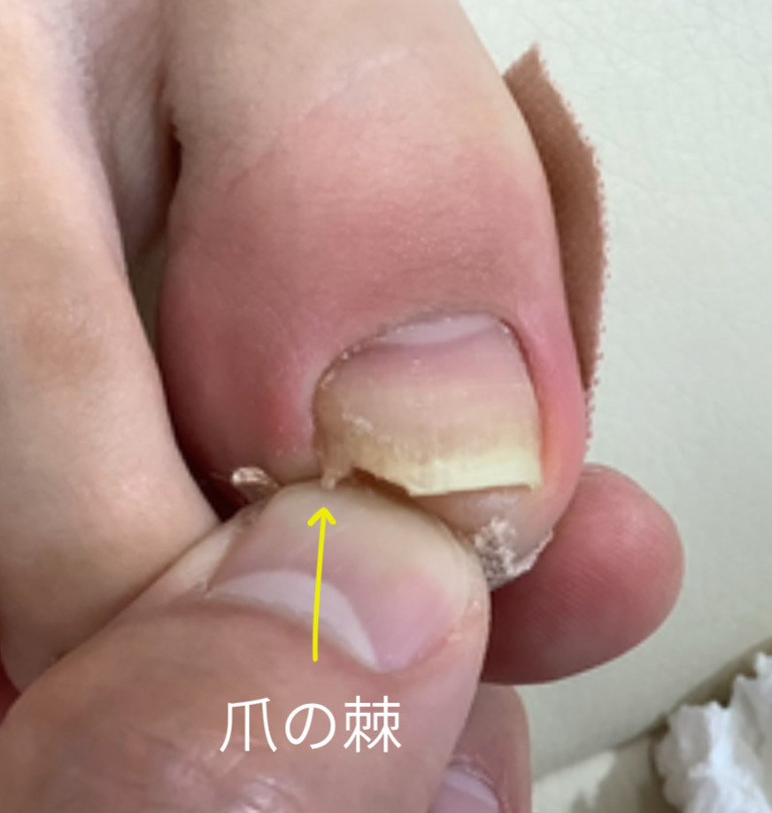 爪の棘の写真