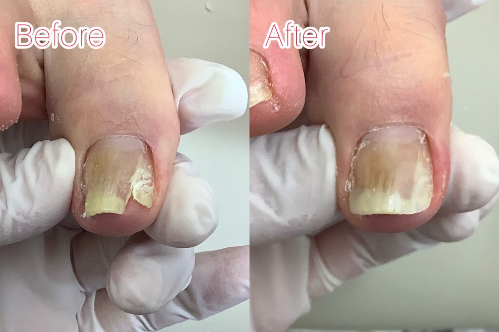 巻き爪のbefore&after写真