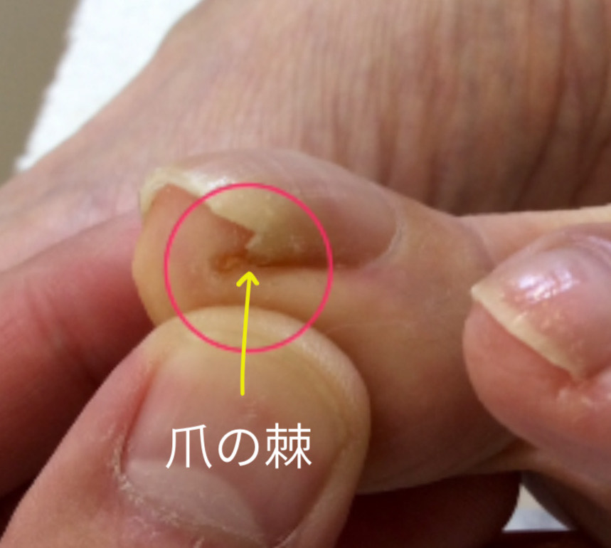 爪の棘の写真