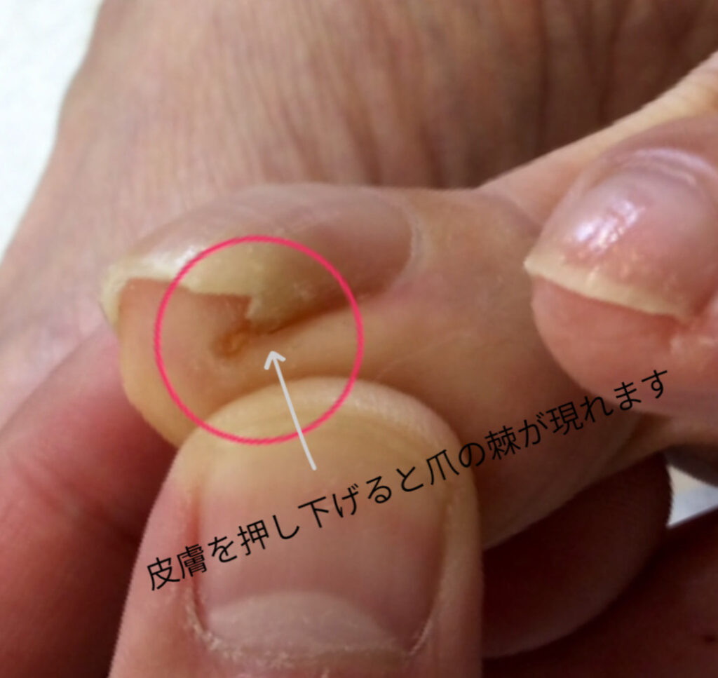 爪の棘の写真
