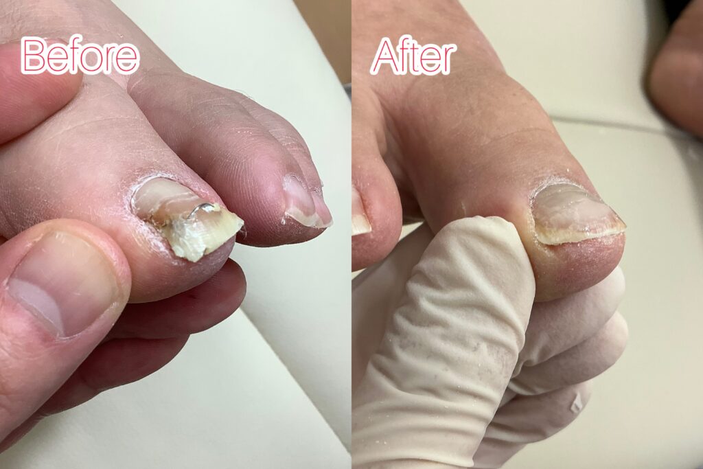 巻き爪のbefore&after写真