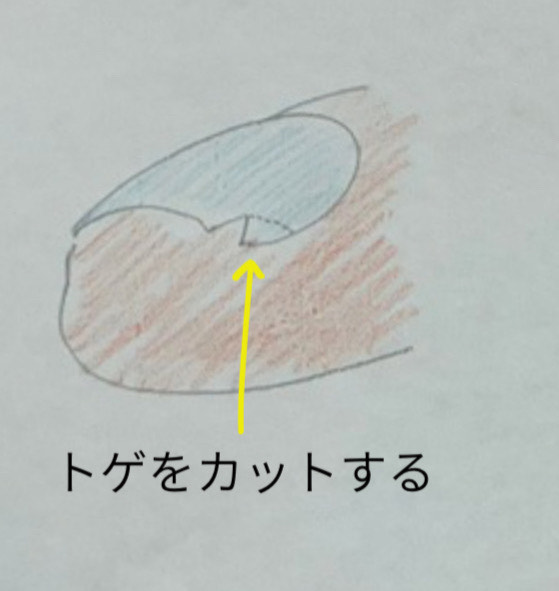 爪の棘の対処方法