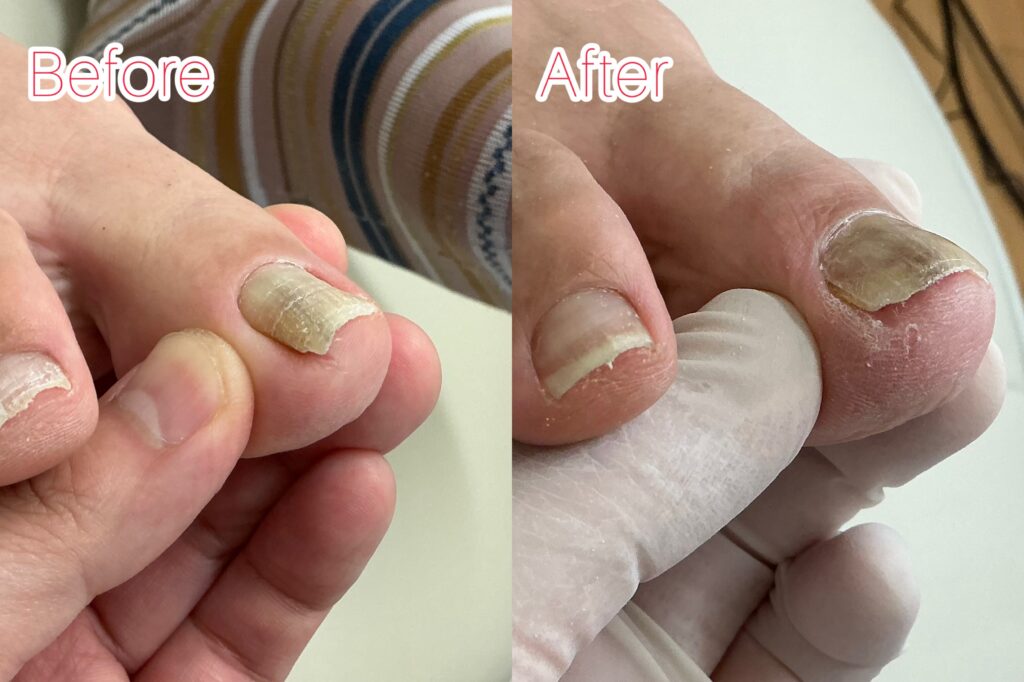 巻き爪のbefore&after写真