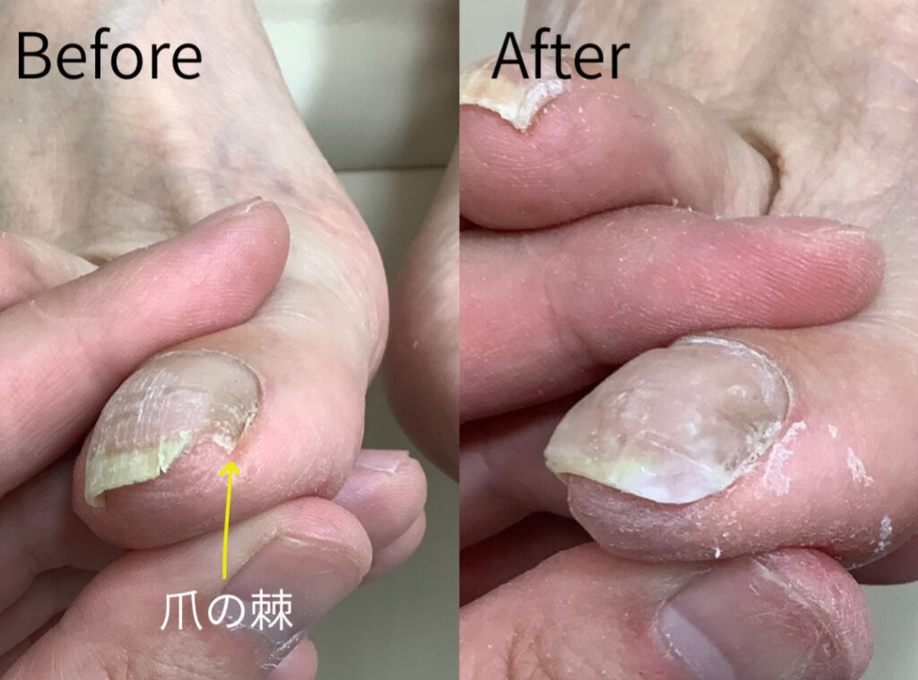 爪の棘の改善