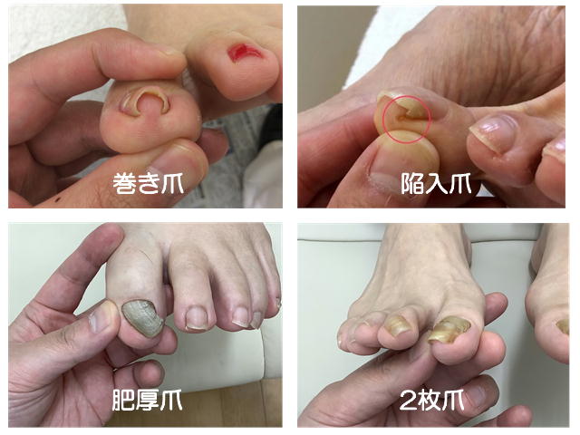 巻き爪・陥入爪・肥厚爪・2枚爪の写真
