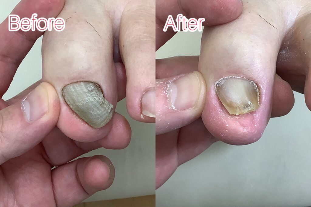 巻き爪のbefore&after写真