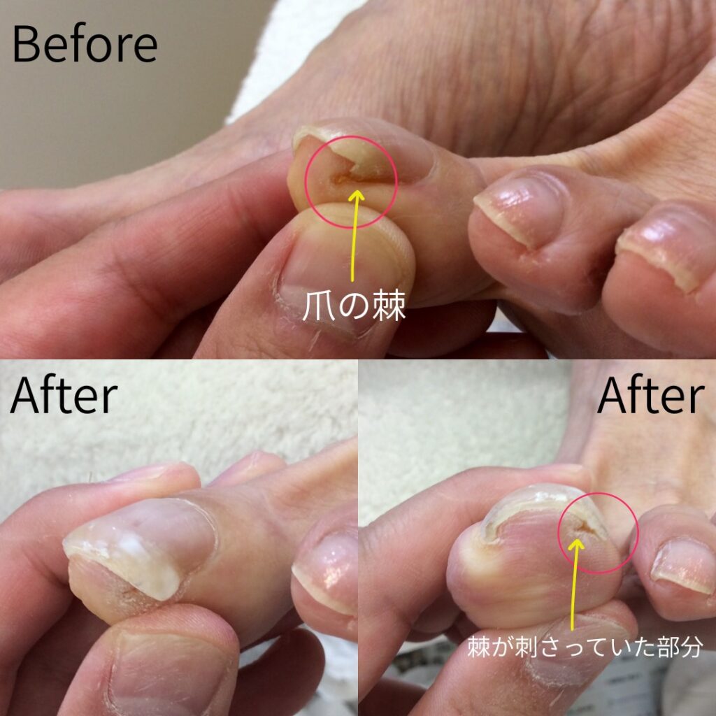 爪のトゲの処置