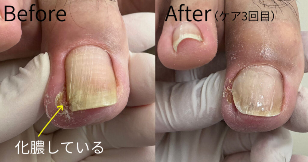 陥入爪が改善