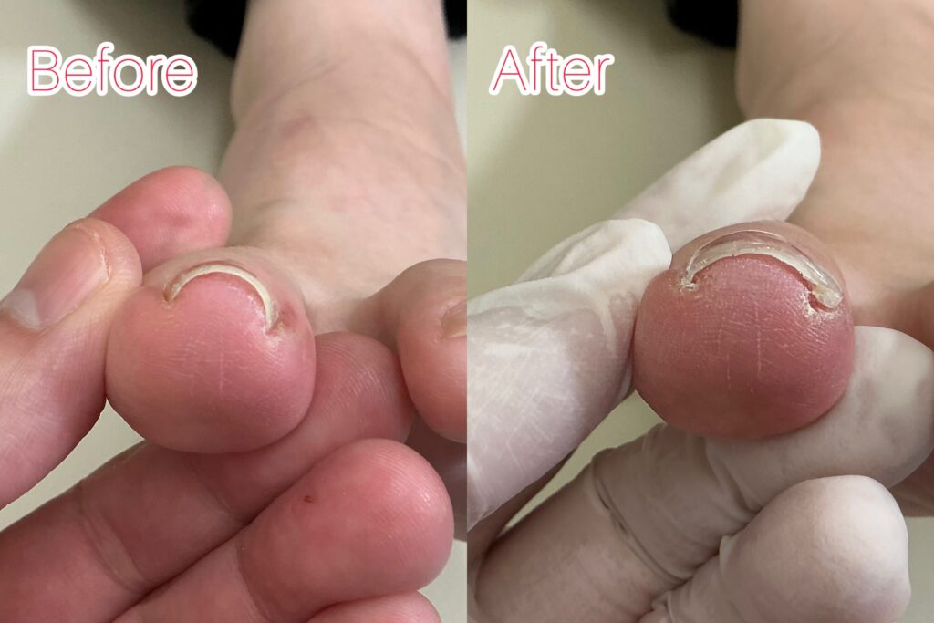 巻き爪のbefore&after写真