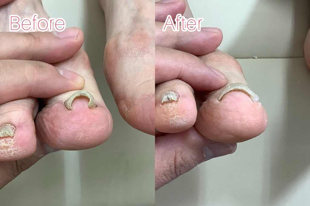 巻き爪のbefore&after写真