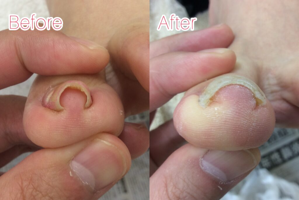 巻き爪のbefore&after写真