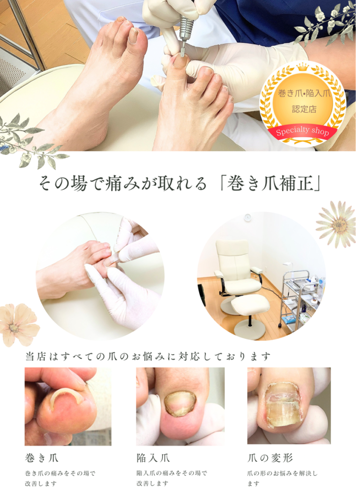 福井巻き爪補正店-坂井市にある巻き爪専門店